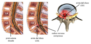 protrusione ernia del disco differenze sintomi