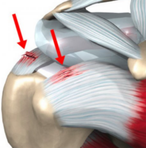 dolore spalla tendinopatia cuffia dei rotatori