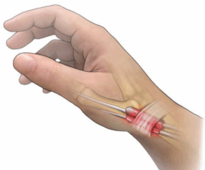 sindrome de quervain