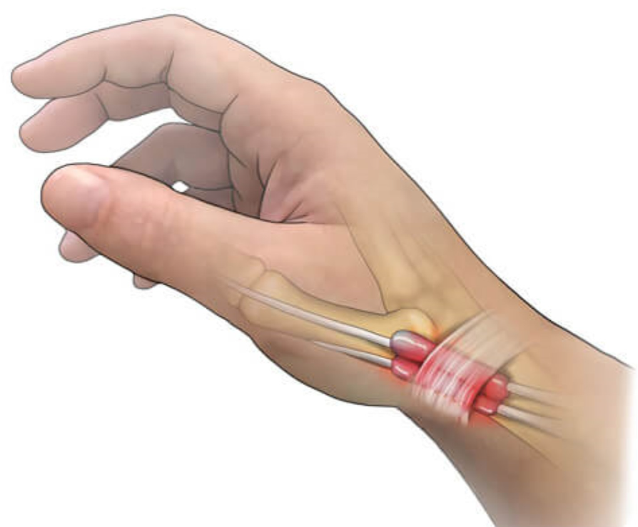 sindrome de quervain