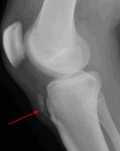 morbo osgood schlatter