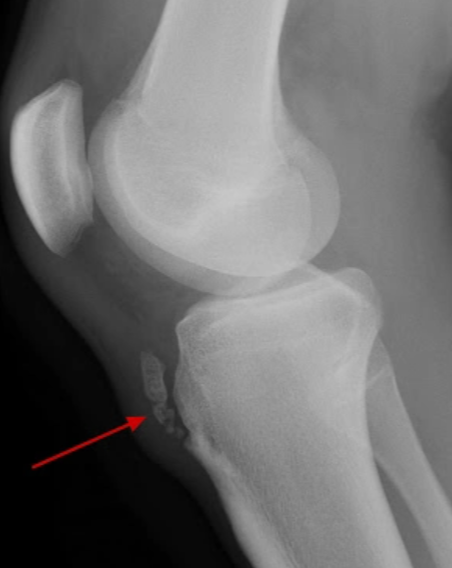morbo osgood schlatter