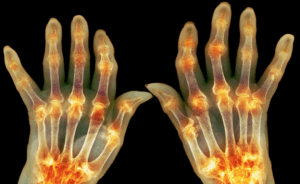 artrite reumatoide definizione sintomi trattamento