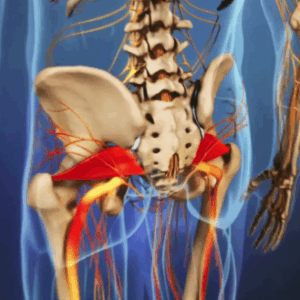 sindrome piriforme