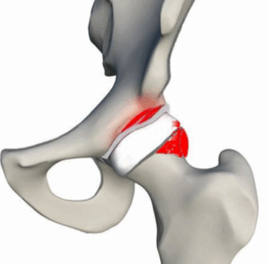 conflitto femoro acetabolare