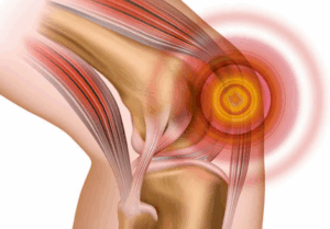 dolore ginocchio sindrome femoro-rotulea