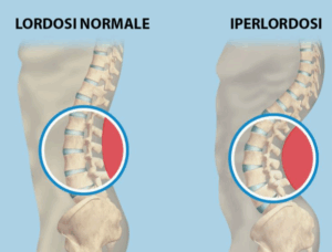 iperlordosi