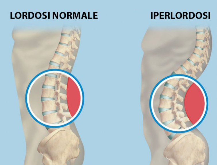 iperlordosi