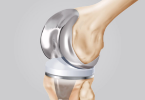 artroprotesi ginocchio