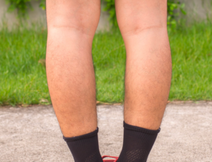 ginocchio varo, definizione, cause e sintomi