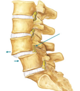 spondilolistesi definizione cause sintomi