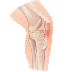 tendinopatia rotulea