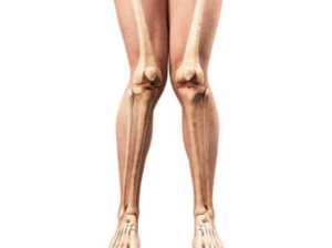 ginocchio valgo definizione cause sintomi