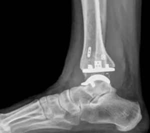 artroprotesi caviglia