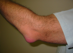 borsite olecranica definizione cause sintomi