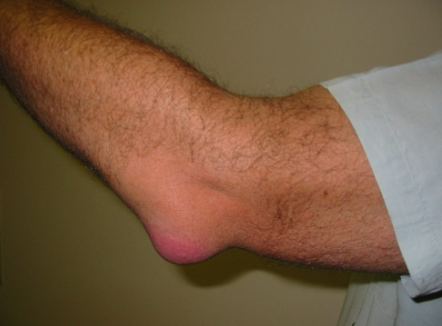 borsite olecranica definizione cause sintomi
