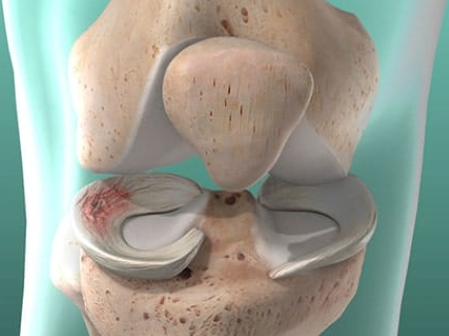 dolore ginocchio lesioni meniscali