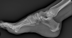 spina calcaneare definizione cause sintomi
